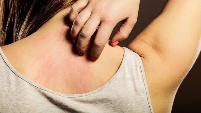 Аллергия на синтетику